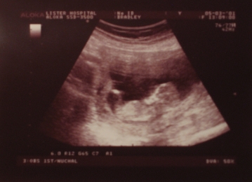 12 week scan